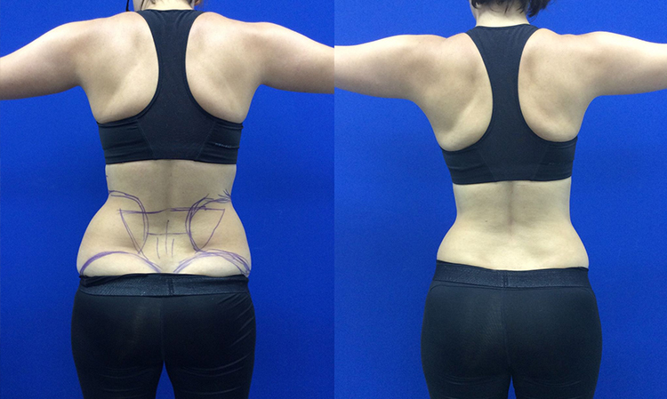 body-sculpting-services